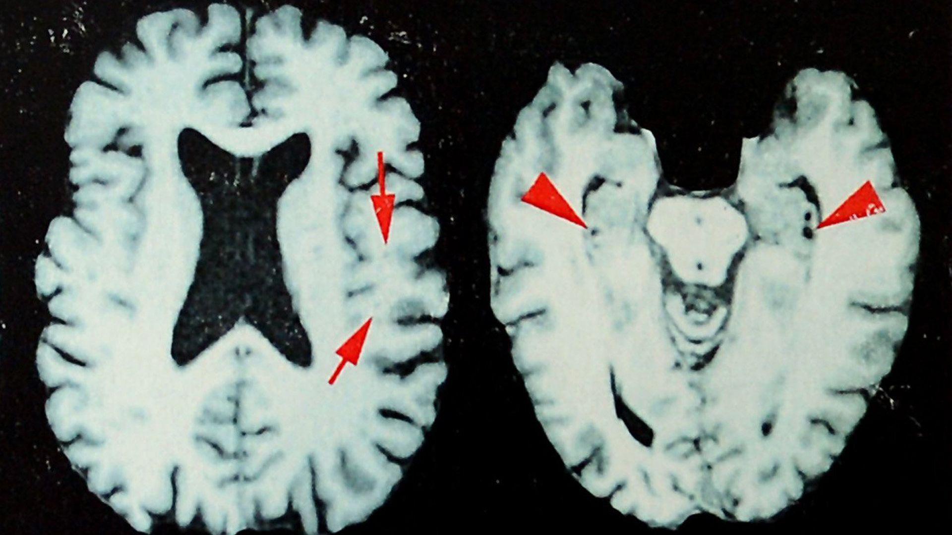 New Study Finds Up to 98% of Deceased NFL Players May Have Suffered Brain Disease