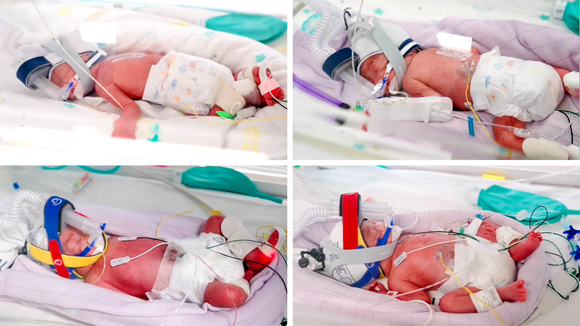 Australia’s Rare Miracle: Identical Quadruplet Girls Born at 28 Weeks