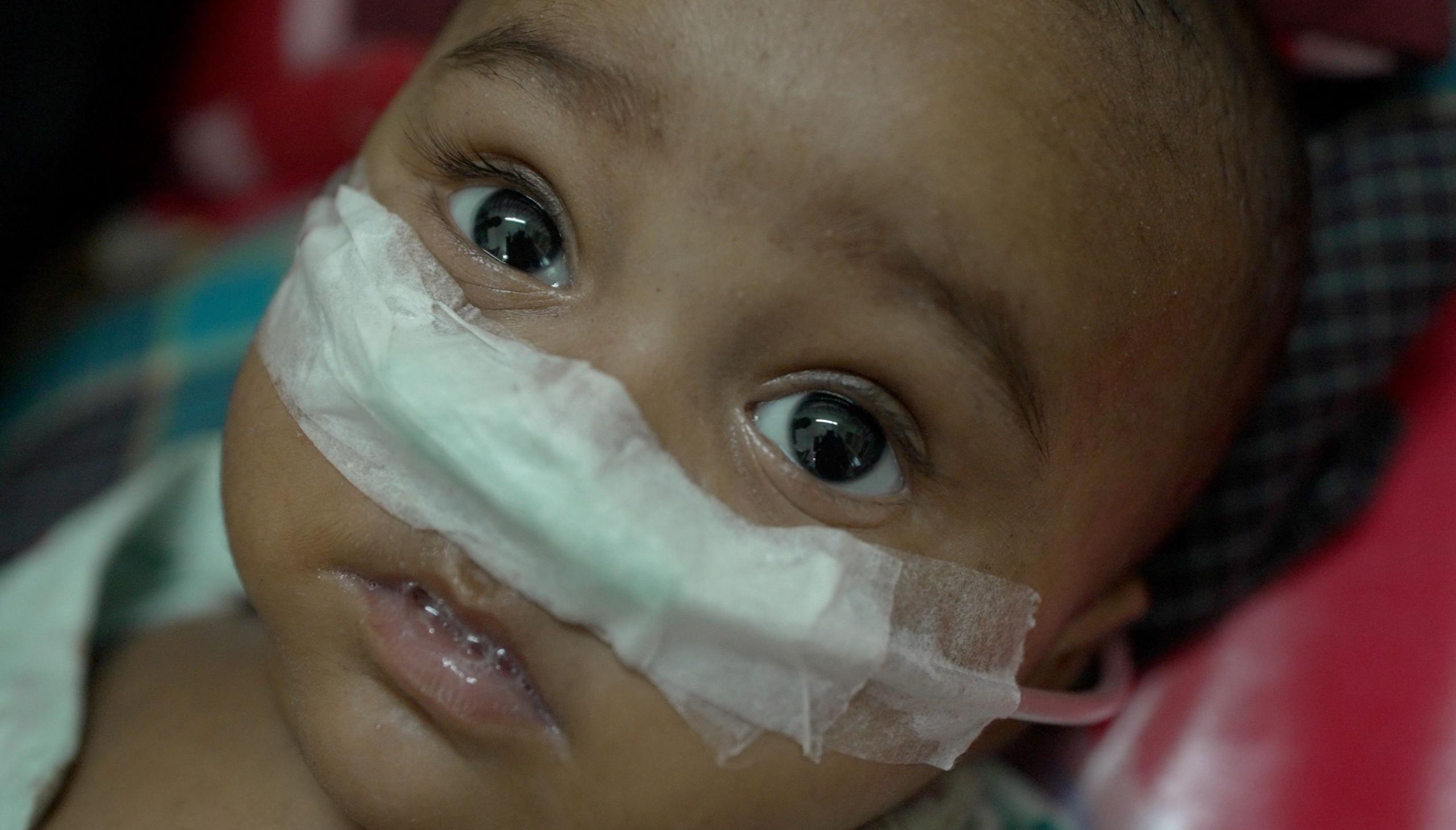 Measles Outbreak Claims Lives as Bangladesh Springs a Vaccine Shortage